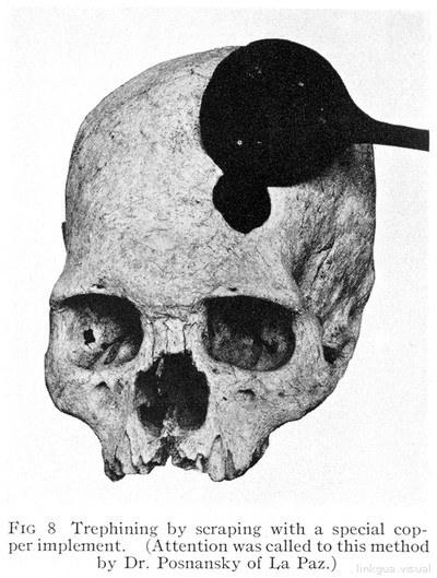 Parte superior de un cráneo e instrumento de trepanación